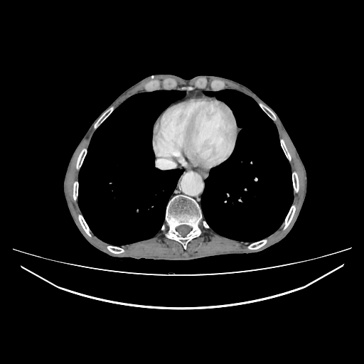 File:Cerebellar metastasis - lung tumor (Radiopaedia 69317-79150 A 27).jpg