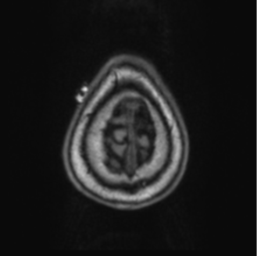 Cerebellar metastasis from lung adenocarcinoma (Radiopaedia 86690-102829 Axial T1 75).png
