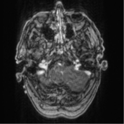 Cerebellar metastasis from lung adenocarcinoma (Radiopaedia 86690-102829 Axial T1 C+ 15).png