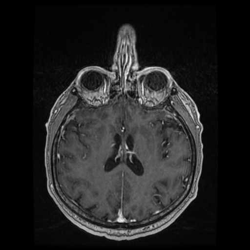 Cerebellar metastasis of pulmonary adenocarcinoma, cavernous venous malformation, and developmental venous anomaly (Radiopaedia 85827-101661 Axial T1 C+ 58).jpg