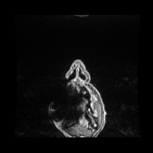File:Cerebellar metastasis of pulmonary adenocarcinoma, cavernous venous malformation, and developmental venous anomaly (Radiopaedia 85827-101661 Coronal T1 C+ 107).jpg