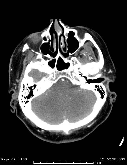 Cerebellar strokes due to intracranial giant cell arteritis (Radiopaedia 68799-78510 CT angiogram 62).jpg