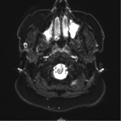 Cerebellopontine angle meningioma (Radiopaedia 48434-53348 Axial DWI 1).png