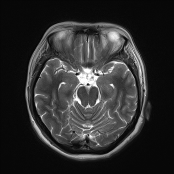 File:Cerebellopontine angle meningioma (Radiopaedia 53561-59591 Axial T2 10).jpg
