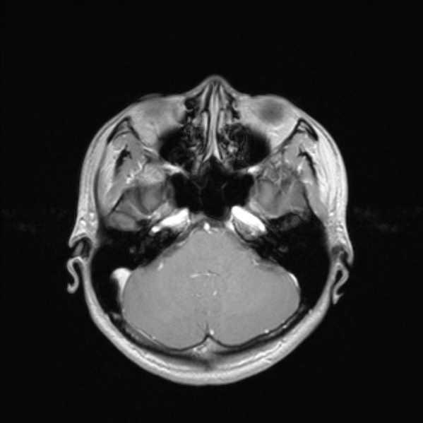 Cerebral abscess (Radiopaedia 24212-24478 Axial T1 C+ 19).jpg