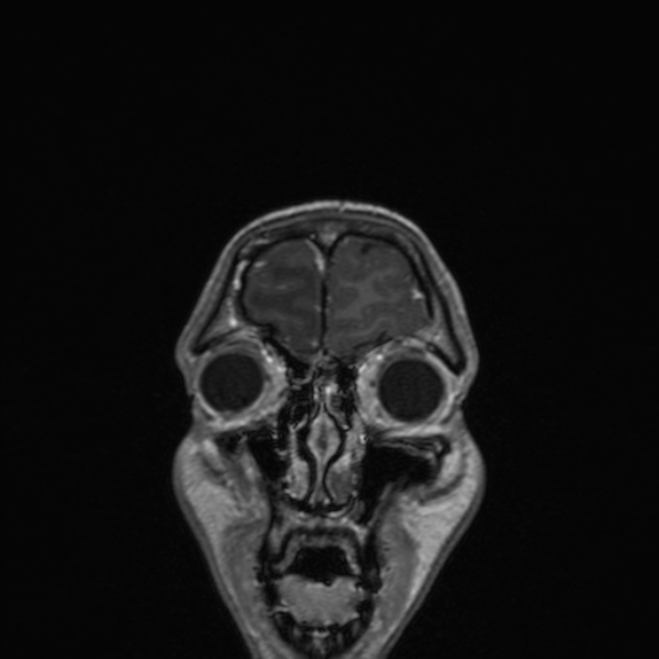 Cerebral abscess (Radiopaedia 24212-24478 Coronal T1 C+ 38).jpg