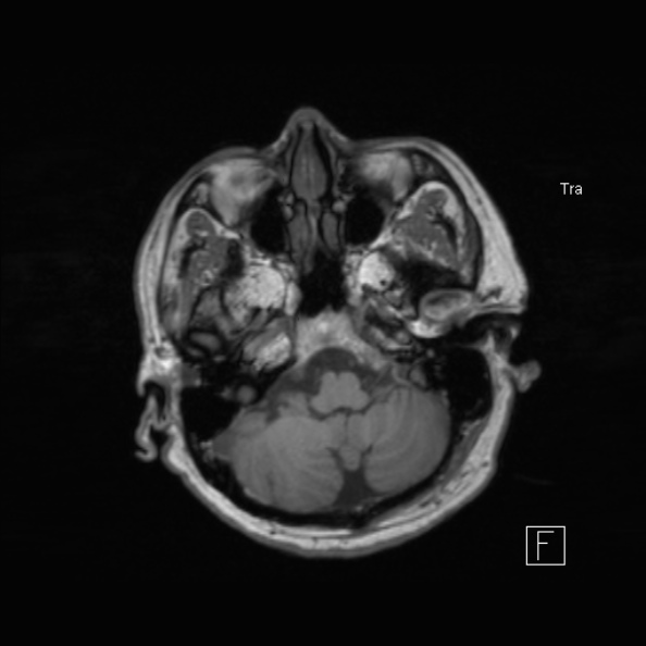 Cerebral abscess (Radiopaedia 26111-26247 Axial T1 18).jpg
