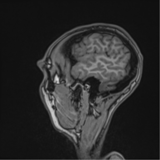 Cerebral abscess (Radiopaedia 60342-68009 Sagittal T1 12).png