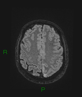 Cerebral abscess and subdural empyema (Radiopaedia 84436-99779 Axial FLAIR 26).jpg