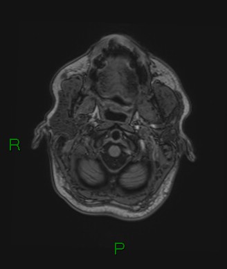 Cerebral abscess and subdural empyema (Radiopaedia 84436-99779 Axial T1 80).jpg