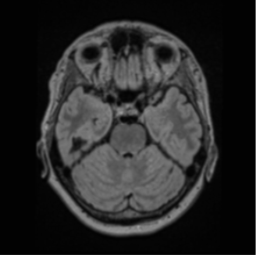 File:Cerebral abscess from pulmonary arteriovenous malformation (Radiopaedia 86275-102291 J 27).png