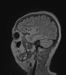 Cerebral abscess from pulmonary arteriovenous malformation (Radiopaedia 86275-102291 Sagittal FLAIR 20).png