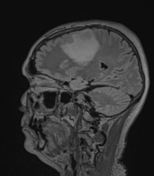 Cerebral abscess from pulmonary arteriovenous malformation (Radiopaedia 86275-102291 Sagittal FLAIR 46).png