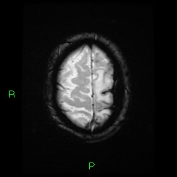 File:Cerebral amyloid angiopathy-associated lobar intracerebral hemorrhage (Radiopaedia 58376-65512 Axial Gradient Echo 4).jpg