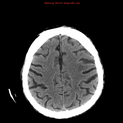 File:Cerebral and orbital tuberculomas (Radiopaedia 13308-13310 Axial non-contrast 21).jpg