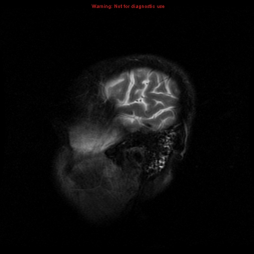 File:Cerebral and orbital tuberculomas (Radiopaedia 13308-13311 Sagittal T2 19).jpg