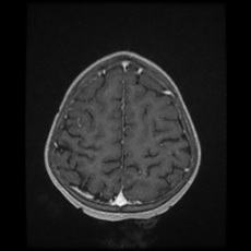 File:Cerebral and spinal tuberculosis (Radiopaedia 90489-107837 Axial T1 C+ 156).jpg