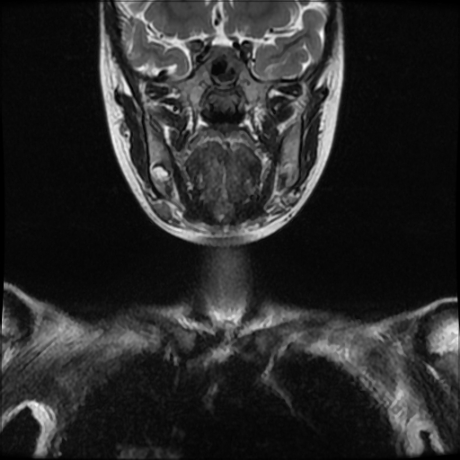 File:Cerebral and spinal tuberculosis (Radiopaedia 90489-107838 Coronal 16).jpg