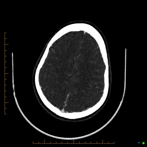 Cerebral arteriovenous malformation (AVM) (Radiopaedia 78162-90706 Axial CTA 209).jpg