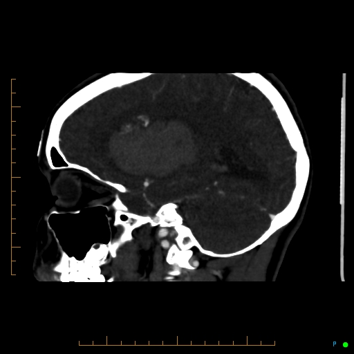 Cerebral arteriovenous malformation (AVM) (Radiopaedia 78162-90706 Sagittal CTA 30).jpg