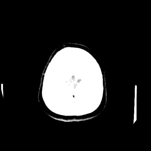 Cerebral arteriovenous malformation (Radiopaedia 28518-28759 Axial non-contrast 70).jpg
