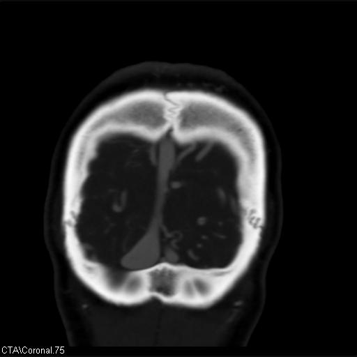 Cerebral arteriovenous malformation (Radiopaedia 28518-28759 C 75).jpg