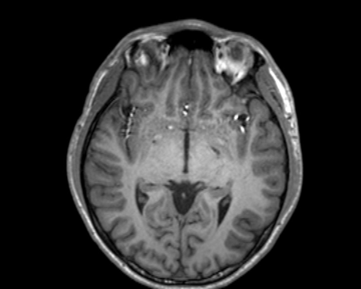 Cerebral arteriovenous malformation (Radiopaedia 30198-30813 Axial T1 35).jpg