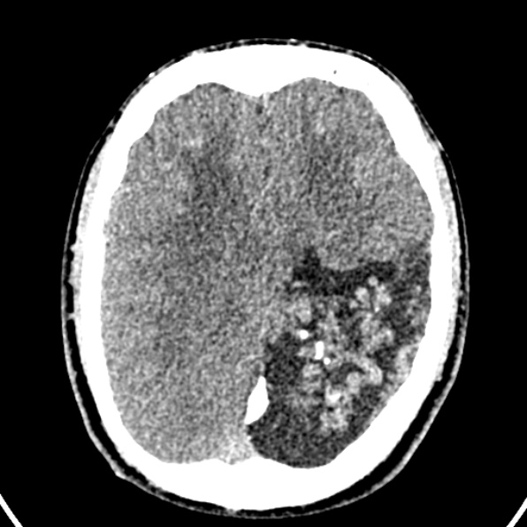 Cerebral arteriovenous malformation (Radiopaedia 37182-39012 Axial non-contrast 32).jpg