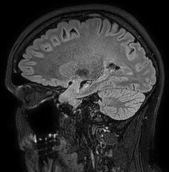 Cerebral arteriovenous malformation (Radiopaedia 74411-85654 Sagittal FLAIR 41).jpg