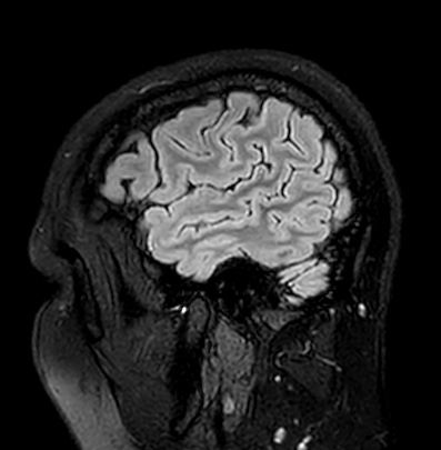 Cerebral arteriovenous malformation (Radiopaedia 74411-85746 Sagittal FLAIR 13).jpg