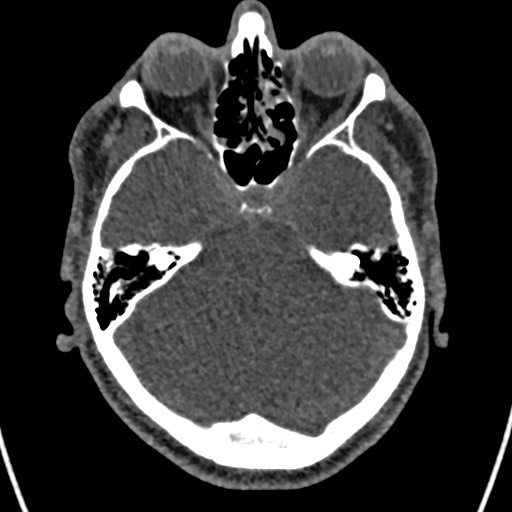 File:Cerebral arteriovenous malformation (Radiopaedia 78188-90746 Axial non-contrast 52).jpg