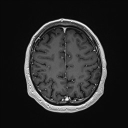 Cerebral arteriovenous malformation (Radiopaedia 84015-99245 Axial T1 C+ 119).jpg