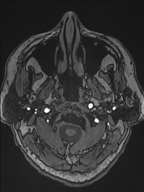 Cerebral arteriovenous malformation (Radiopaedia 84015-99245 Axial TOF 21).jpg