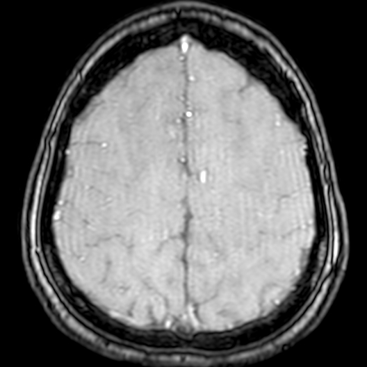 Cerebral arteriovenous malformation at posterior body of corpus callosum (Radiopaedia 74111-84925 Axial MRA 178).jpg