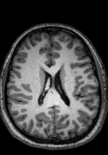 Cerebral arteriovenous malformation at posterior body of corpus callosum (Radiopaedia 74111-84925 Axial T1 110).jpg