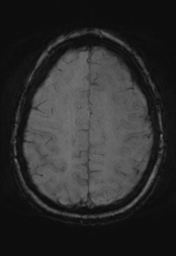 File:Cerebral cavernoma and development venous anomaly (Radiopaedia 37603-39482 Axial SWI 30).png