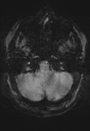 File:Cerebral cavernoma and development venous anomaly (Radiopaedia 37603-39482 Axial SWI 7).png