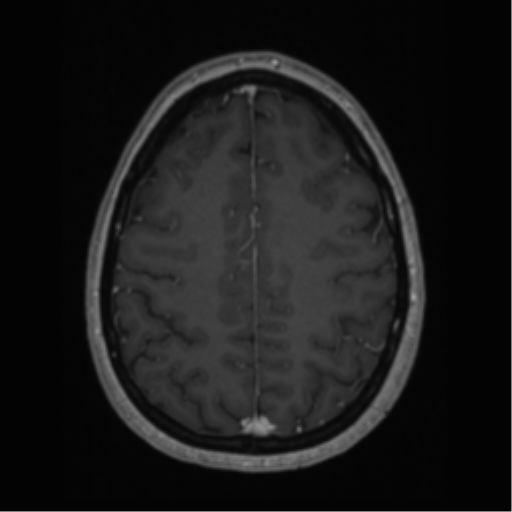 Cerebral cavernoma and development venous anomaly (Radiopaedia 37603-39482 Axial T1 C+ 56).png