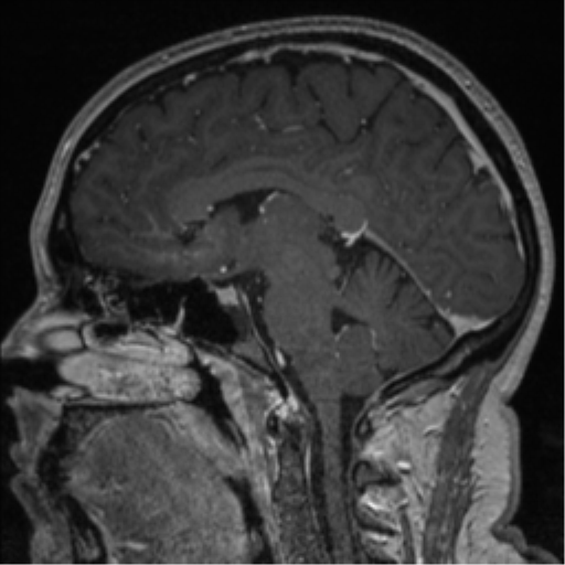 Cerebral cavernoma and development venous anomaly (Radiopaedia 37603-39482 Sagittal T1 C+ 46).png