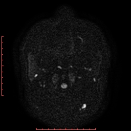 File:Cerebral cavernous malformation (Radiopaedia 26177-26306 Axial DWI 1).jpg