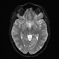 Cerebral cavernous venous malformation (Radiopaedia 70008-80021 Axial DWI 14).jpg