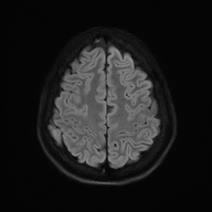 Cerebral cavernous venous malformation (Radiopaedia 70008-80021 Axial DWI 55).jpg
