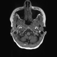 Cerebral cavernous venous malformation (Radiopaedia 70008-80021 Axial T1 4).jpg