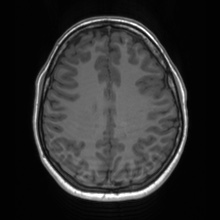 Cerebral cavernous venous malformation (Radiopaedia 70008-80021 Axial T1 52).jpg