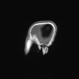 File:Cerebral cavernous venous malformation (Radiopaedia 70008-80021 Sagittal T1 73).jpg