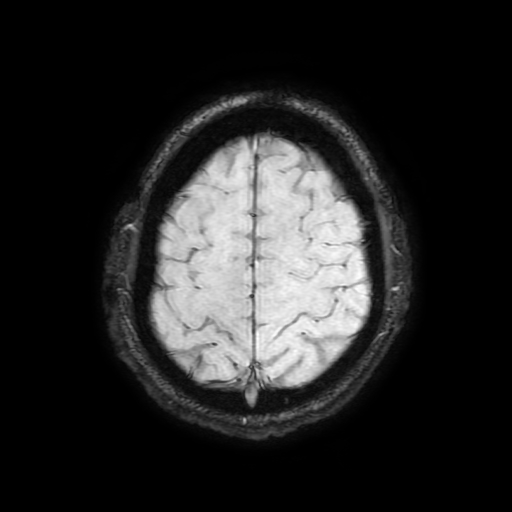 Cerebral cavernous venous malformation (Zabramski type II) (Radiopaedia 85511-101198 Axial SWI 98).jpg