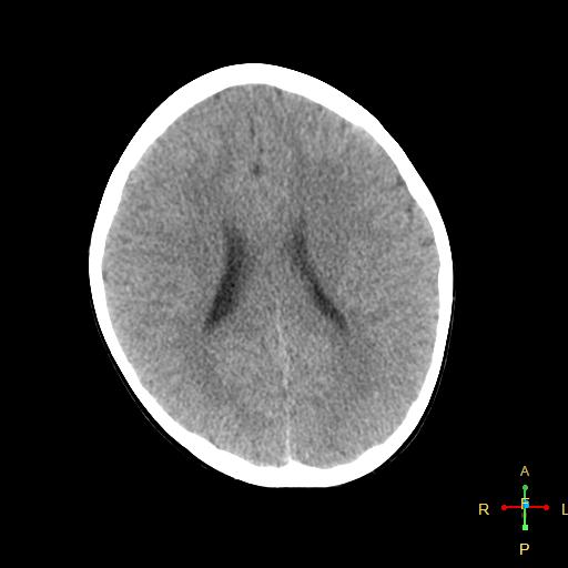 File:Cerebral contusion (Radiopaedia 48869-53911 Axial non-contrast 12).jpg