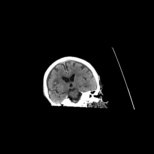 File:Cerebral contusions, subarachnoid hemorrhage and subdural hygromas (Radiopaedia 55399-61829 Axial non-contrast 1).png