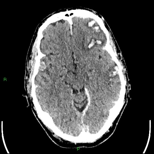 Cerebral contusions (Radiopaedia 33868-35039 Axial non-contrast 84).jpg
