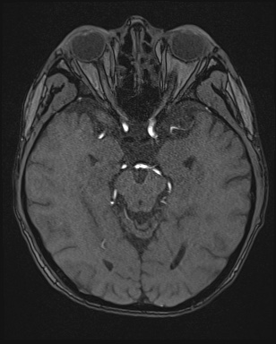 Cerebral embolic infarcts (embolic shower) (Radiopaedia 72391-82921 Axial MRA 61).jpg